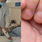 Thường xuyên cắn móng tay, bé 9 tuổi nhập viện phẫu thuật ba lần mới qua khỏi, mẹ ray rứt vì ngỡ bình thường