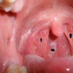 6 dấu hiệu dễ nhận biết báo hiệu ung thư vòm họng giai đoạn đầu
